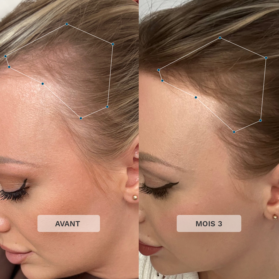 Formule Capillaire Avancée+